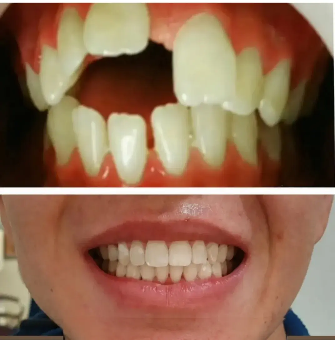 Ortodontia — registro fotográfico de caso clínico real, antes e depois